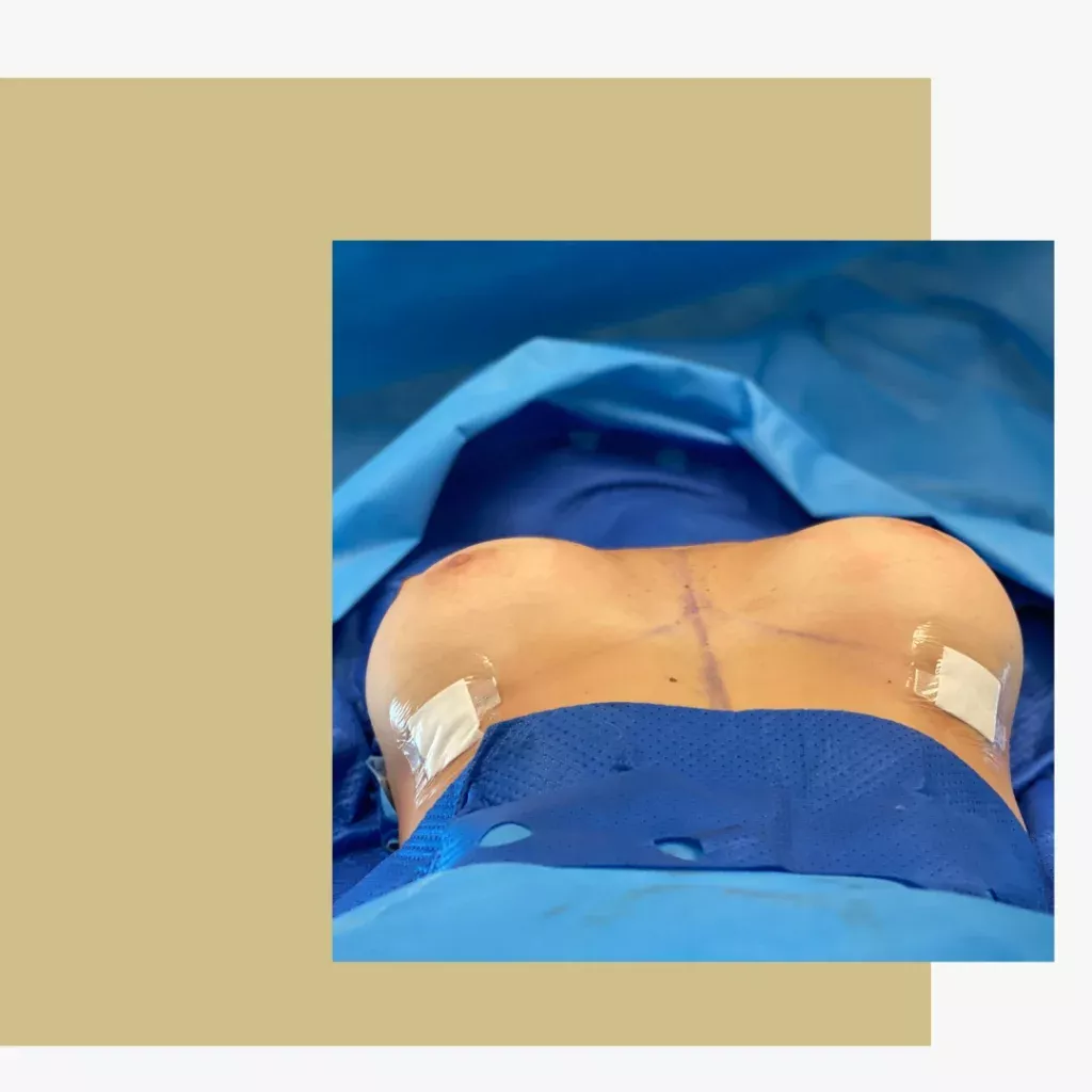 Cirurgia de Aumento mamário