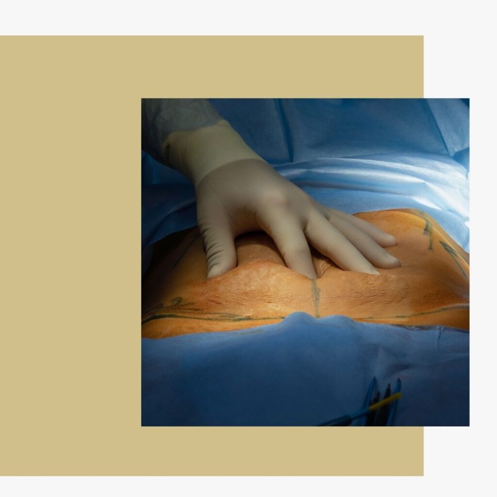 O que é a Abdominoplastia