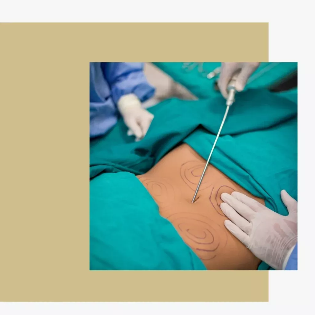 O que é a Lipoabdominoplastia