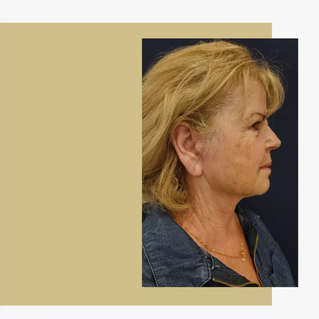 Para quem está indicado o Dermalift