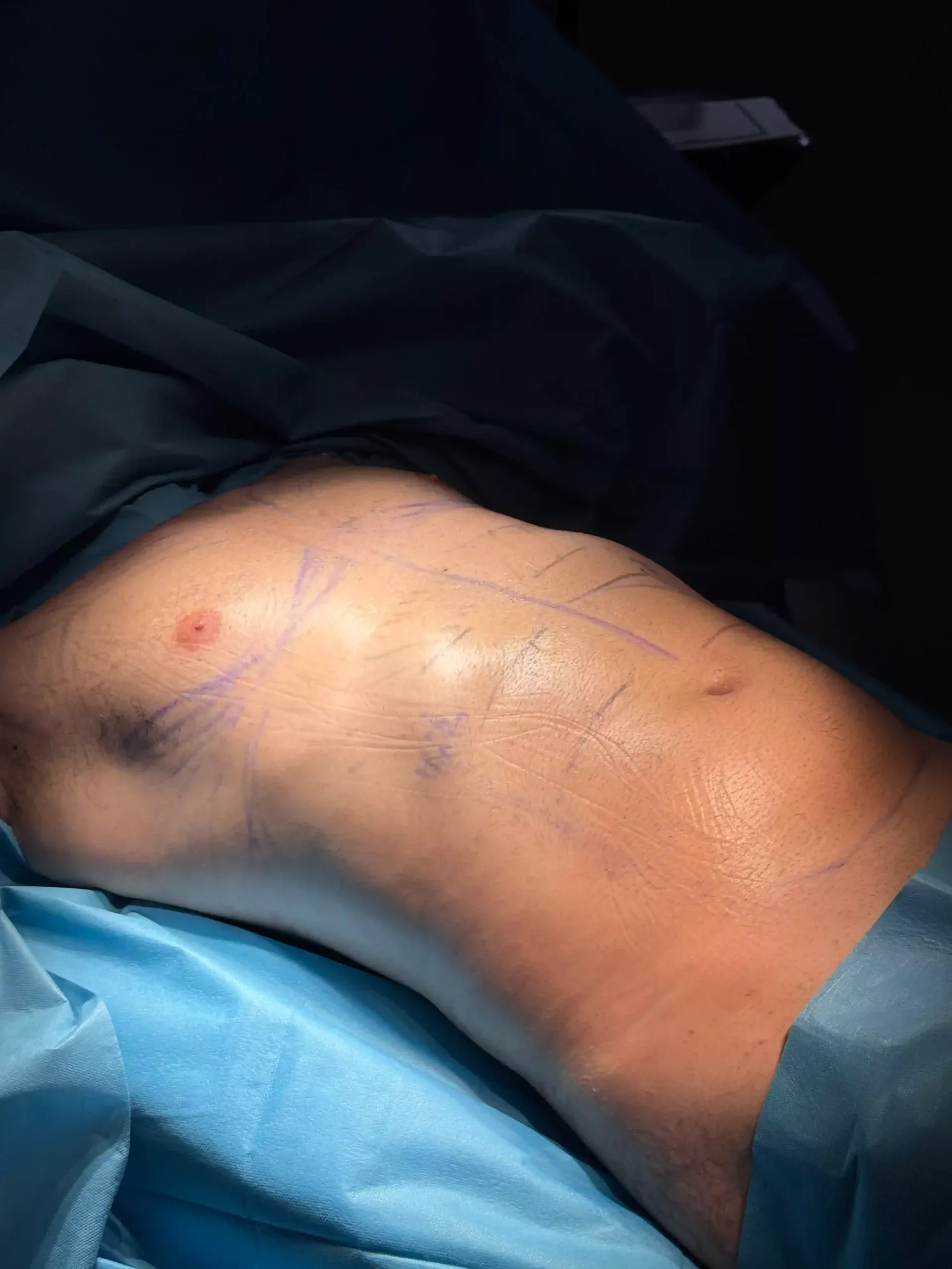 Recuperacao ginecomastia I Clínica Ana Silva Guerra