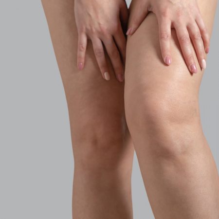 Sintomas do Lipedema